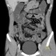 Chronic appendicitis, mimic of Crohn's disease, CT enterography: CT - Computed tomography